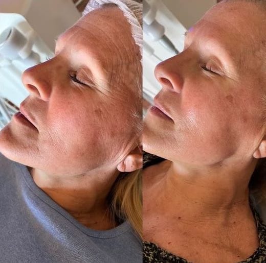 CryoLift Facial before and after results