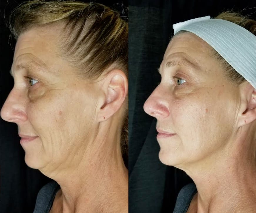 CryoLift Facial before and after results