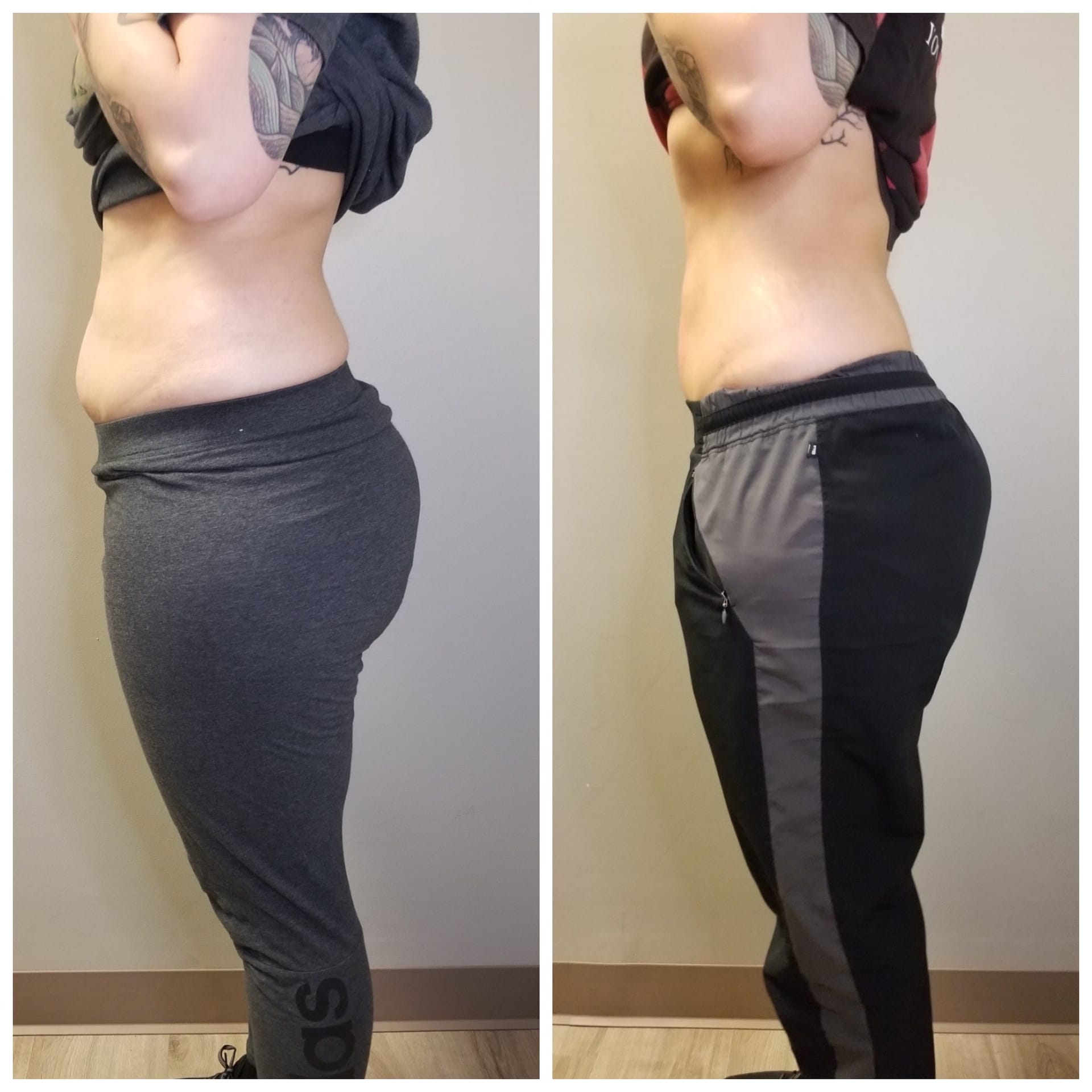 Cryo Slimming before and after results