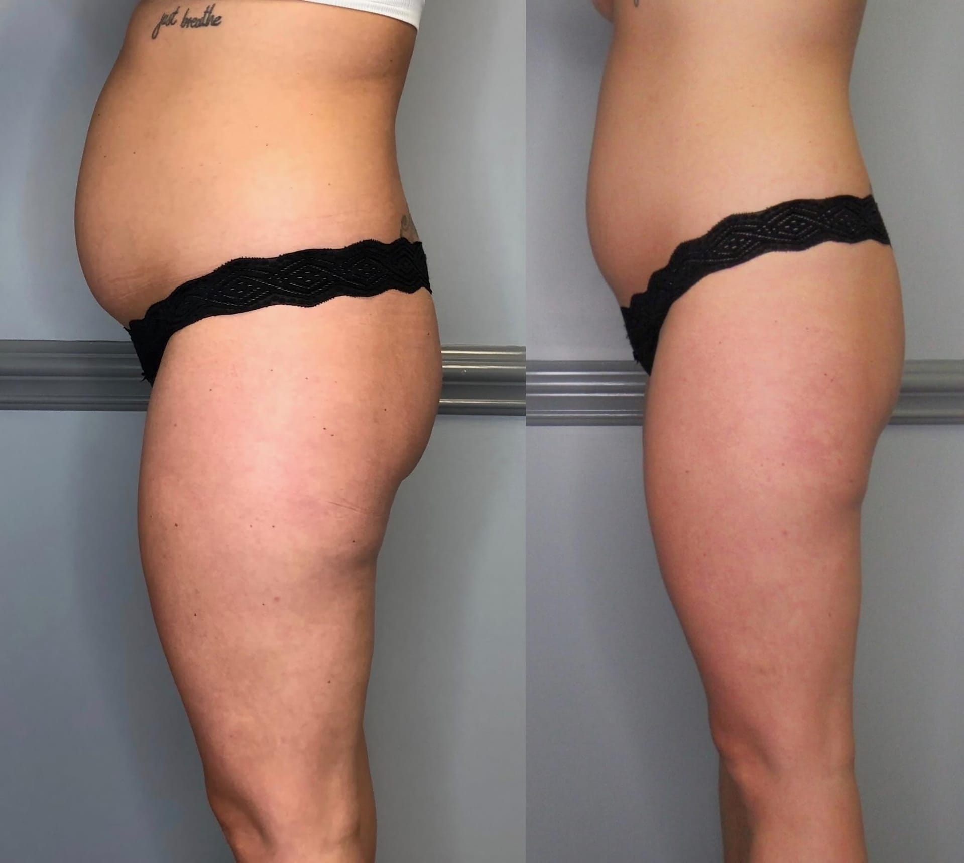 Cryo Toning before and after results