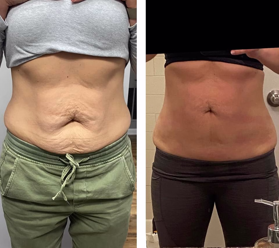 Cryo Toning before and after results